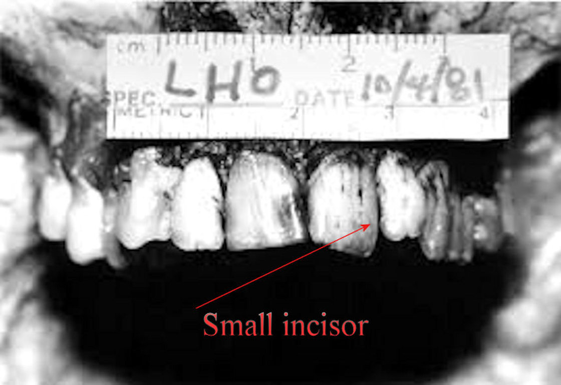 Harvey-Oswald-teeth-1981-a.jpg