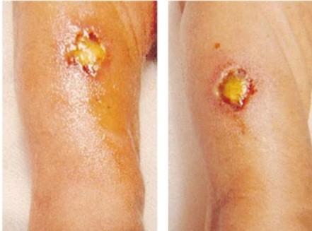 Hemorrhagic bullae and necrotic ulcers with black eschar (ecthyma gangrenosum) in a neonate