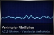 ventricular fibrillation