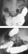 Neonate with Hirschsprung disease showing abdominal distension, possible transition zone on contrast enema