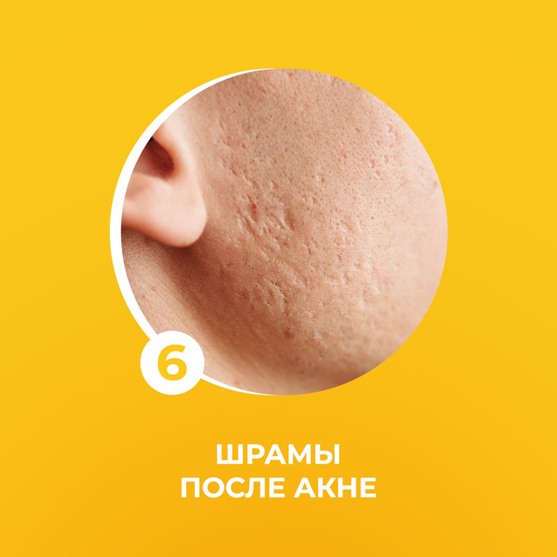 Шрамы после акне