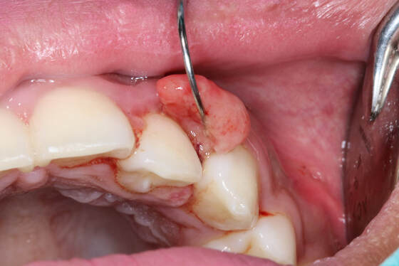 Biopsy & Cyst Removal