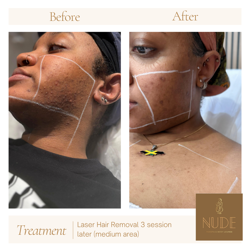 Laser Hair Removal Result