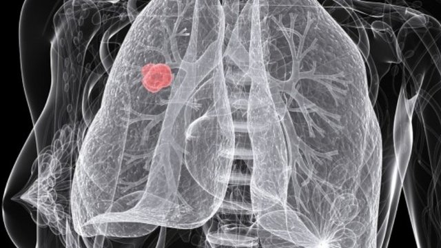 lung-cancer.jpg
