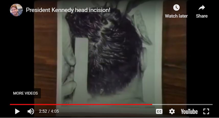 kennedy-incision-youtube-film.jpg