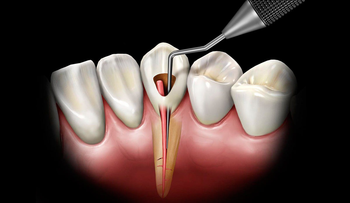 Как проходит лечение корневых каналов