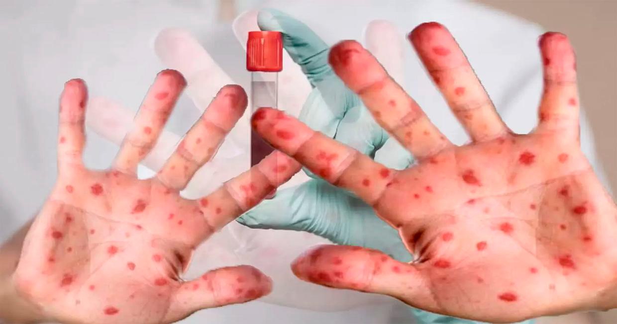 ¿Cómo se contagia la gripe del tomate? Nueva alerta sanitaria 