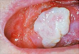 Periodontitis