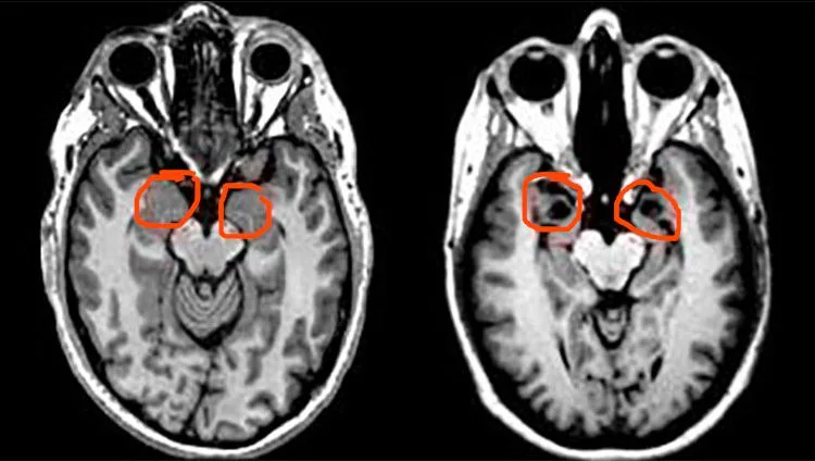 brain-scan