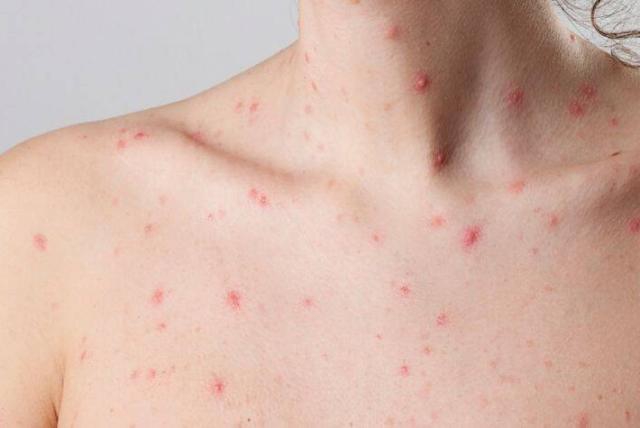 Viruela del mono: Brasil empata con México en casos confirmados