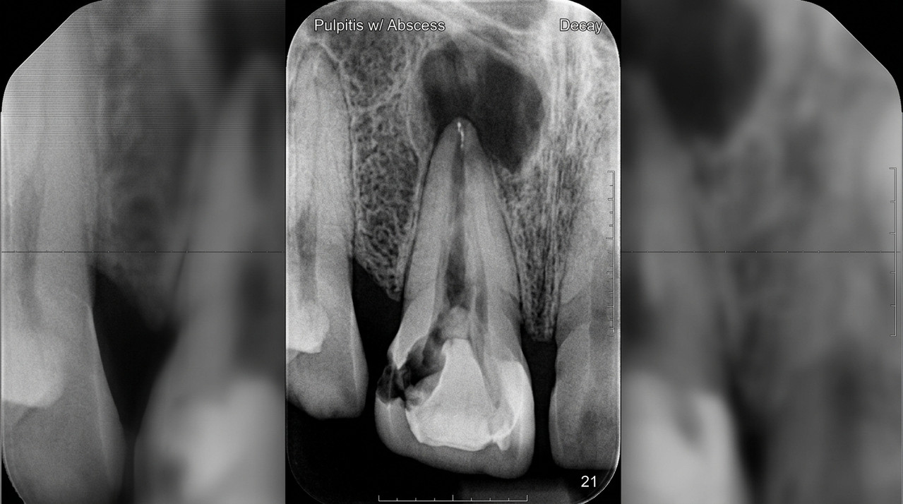 Рентгеновский снимок зуба с кариесом и пульпитом