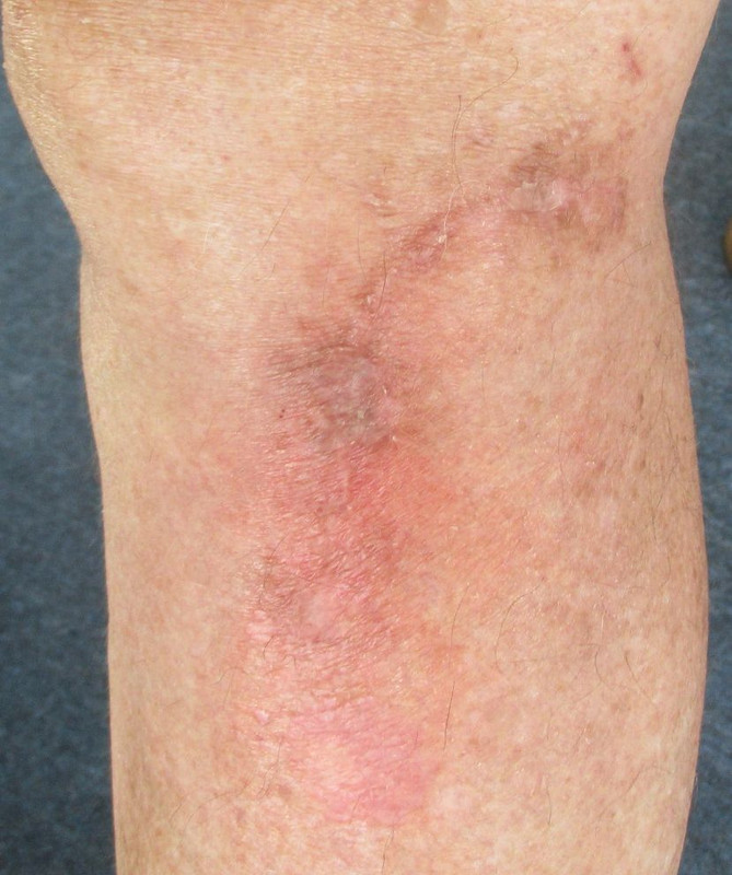 [Image: leg-infection08.jpg]