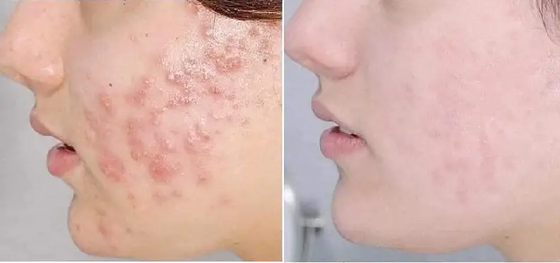 Hình ảnh thực tế da bị nhiễm Corticoid