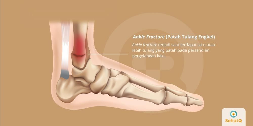 Ankle Fracture (Patah Tulang Engkel)
