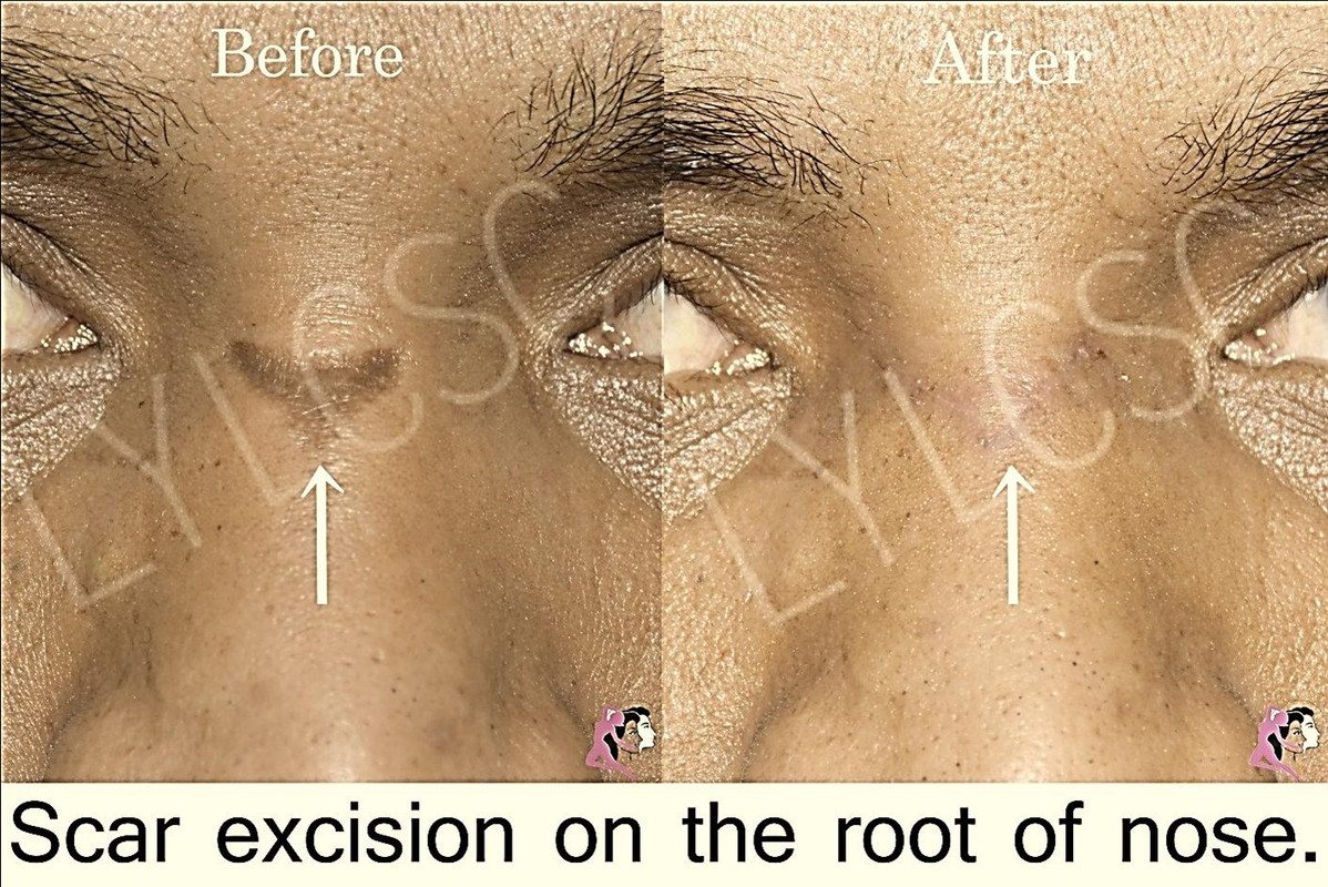 Body Scars Treatment - Look Young Laser & Cosmetic Surgery Center