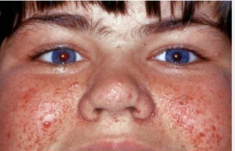 Clinical photograph showing multiple erythematous papules and nodules (facial angiofibromas) in a butterfly distribution across the cheeks and nose, characteristic of tuberous sclerosis complex