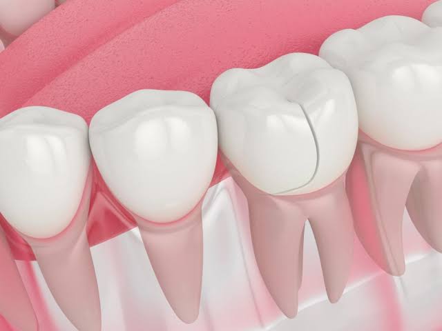 How to Fix a Cracked Tooth Naturally: Comprehensive Guide to Natural Remedies