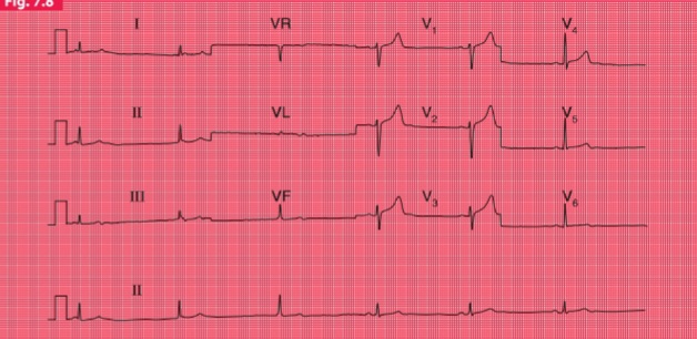 ECG showing Sick Sinus Syndrome – sinus bradycardia, pauses, alternating tachycardia