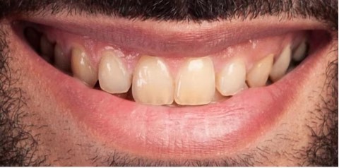 Before Whitening