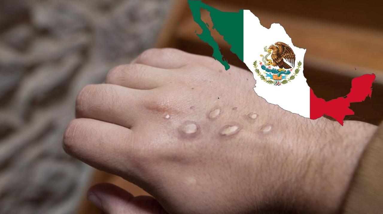 ¿En dónde fue el primer caso de viruela del mono México?