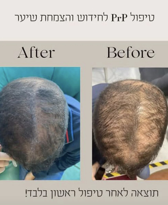 לפני ואחרי