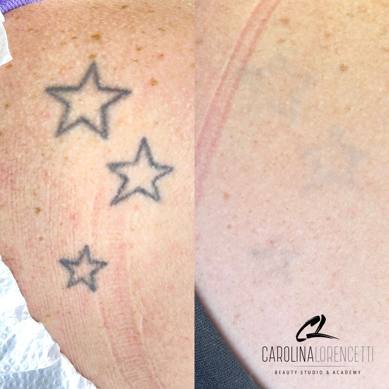 Remoção de Tatuagem