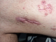 Getting surgery soon