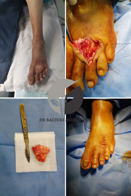 Lipome au dos du pied traité par Dr. Bachiri