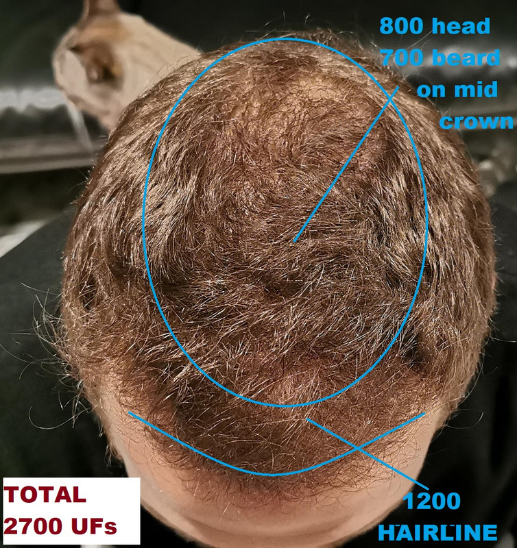 1200-head-to-hairline-800-head-700-beard-mid-crown-total-2000-head-700-beard