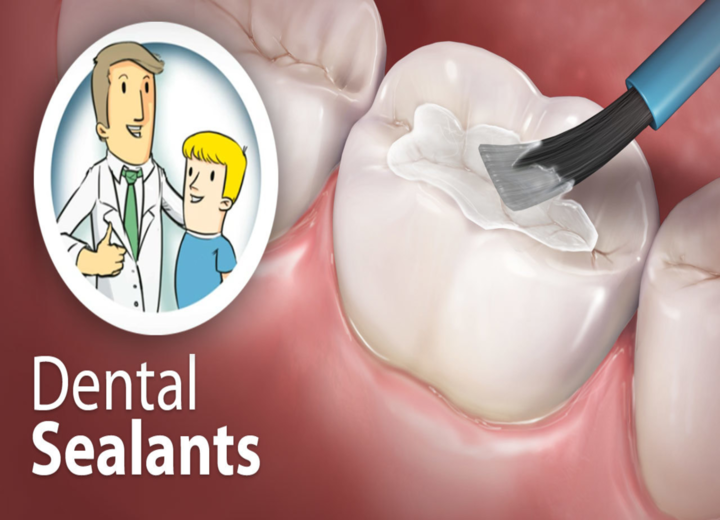 Dental Sealants