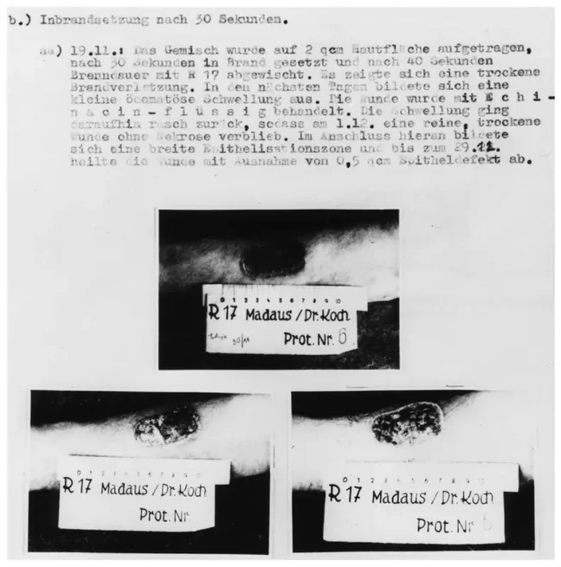 Foto de heridas dejadas por un experimento médico. La víctima había sido quemada con fósforo para poder probar los medicamentos