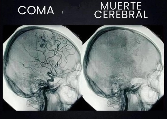 fotocerebro1