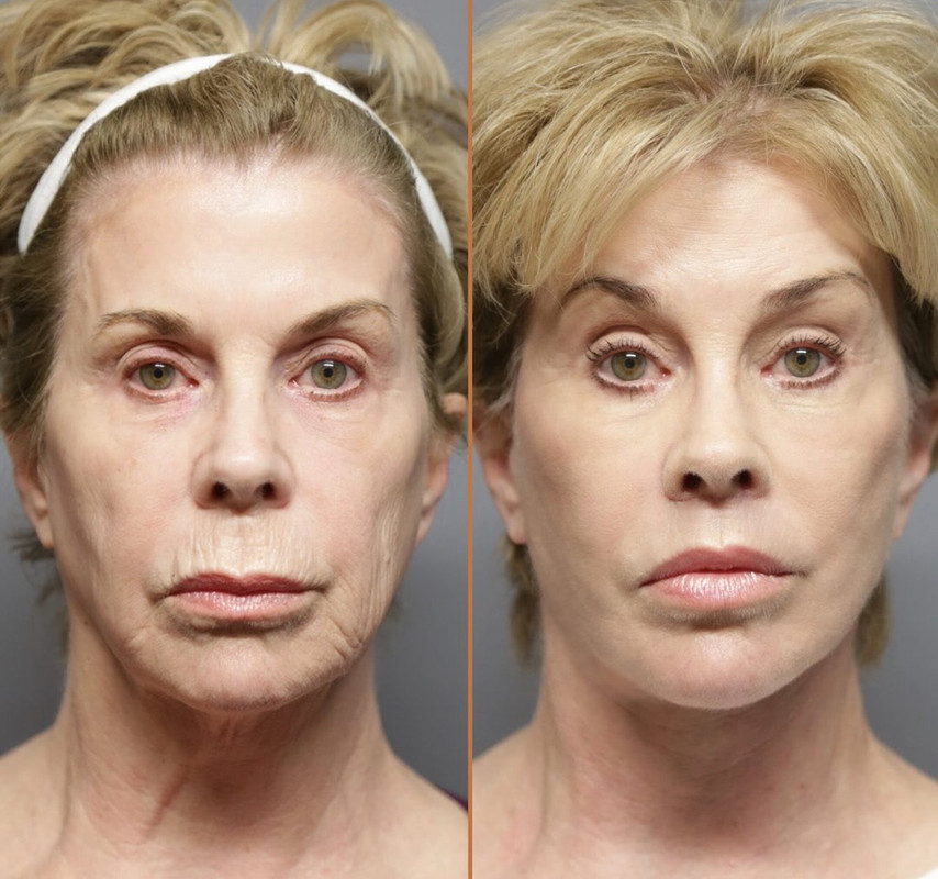 Résultat peau – fermeté