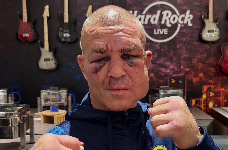 Гари Фокс показа как изглежда след битката си в BKFC
