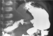 Infant with hypertrophic pyloric stenosis showing gastric distension and visible peristalsis