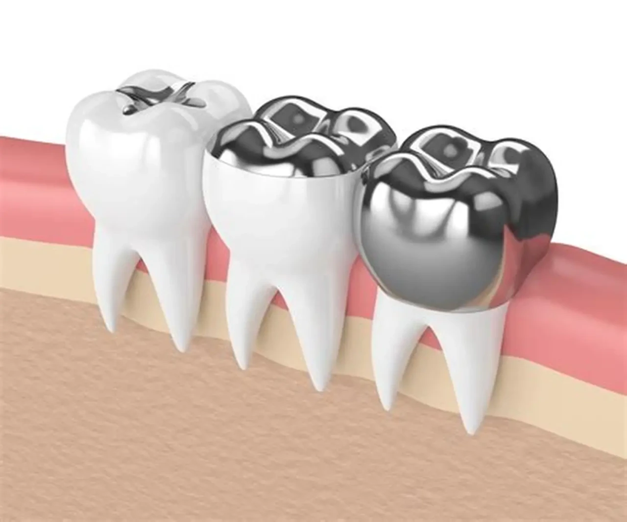 Dental Filling Evaluation
