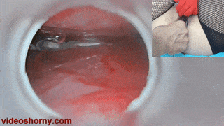 Impregnation with cum in cervix and endoscope camera in uterus