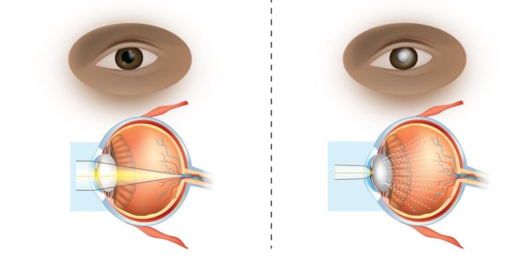 Катаракта - причины, симптомы, методы лечения и профилактики