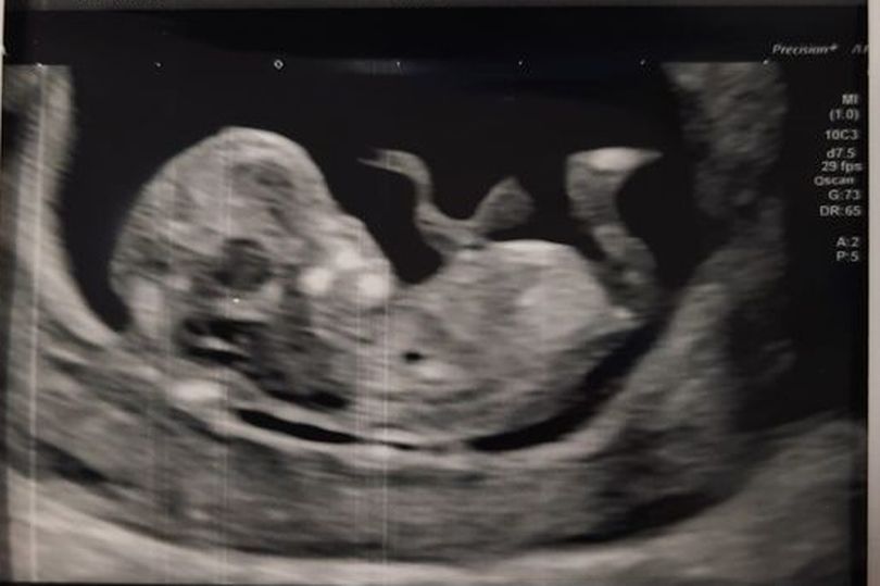 0-pay-spurs-crest-baby-scan-231232
