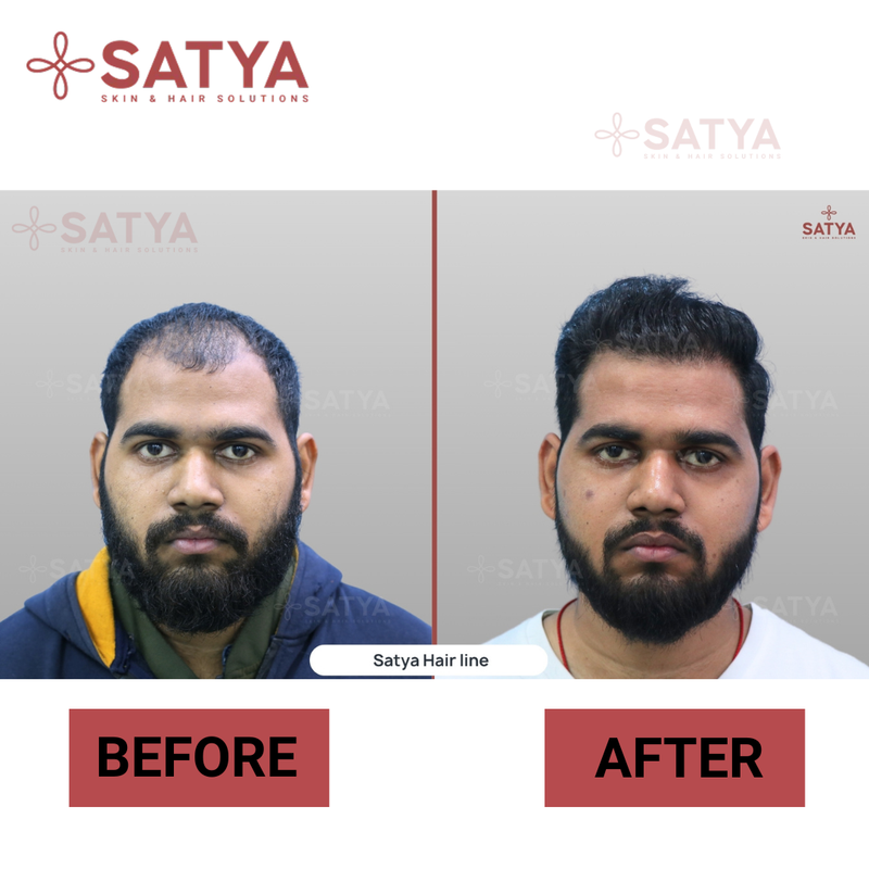Hair Transplant Cost Per Graft India