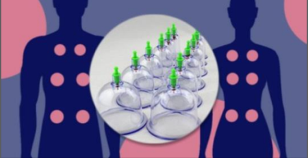 Understanding Cupping Therapy - The Basics Understanding Cupping Therapy - The Basics