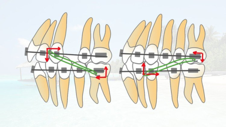Orthodontic biomechanics and anchorage