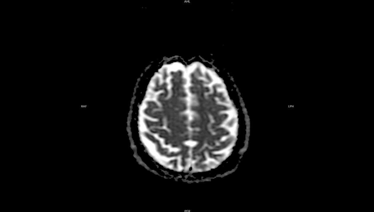 13670246 BUJAN MARCELO (INT) 20250509 Apparent Diffusion Coefficient (mm2 s) 20 20