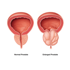 Prostate Growth