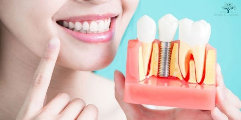 Dental Implants Preserve Healthy Teeth