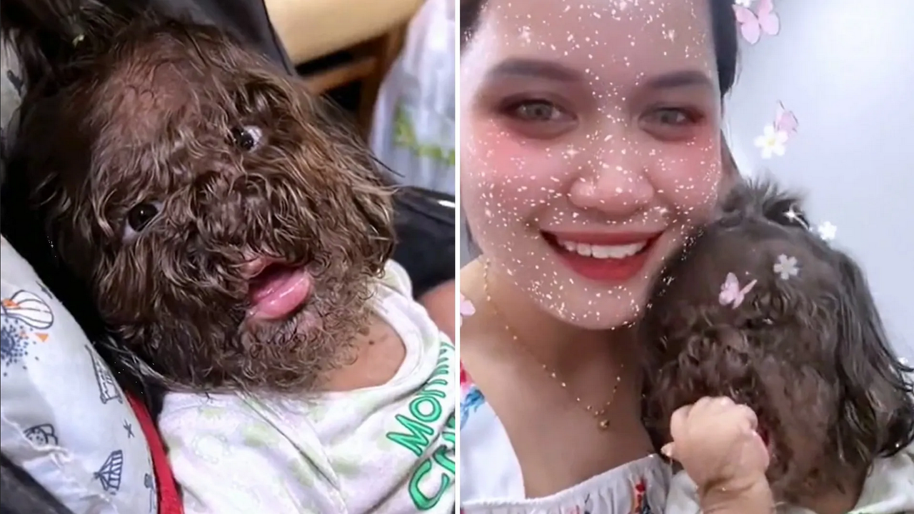 Niña con cabello en el rostro se vuelve viral por su inusual condición (Video)