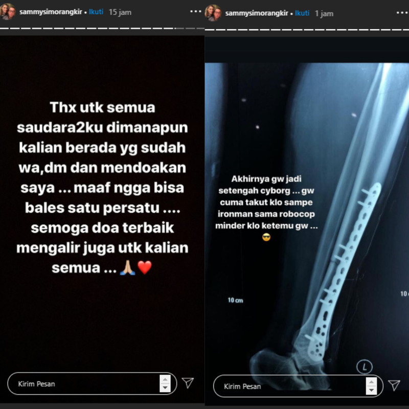 Unggahan Sammy Simorangkir setelah operasi
