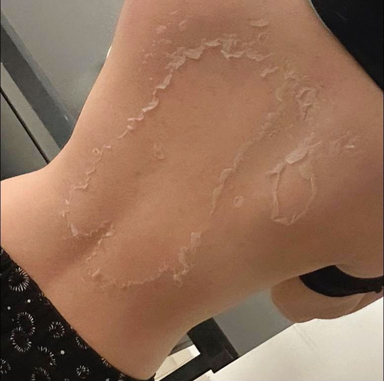 Tratamento corporal com peeling