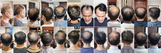Folli-Heal Plus Hair Growth Before and After