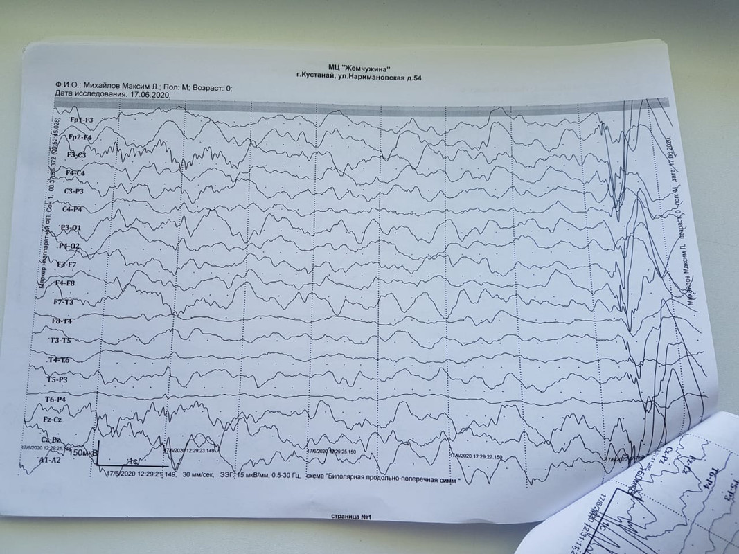 Ээг кемерово. ЭЭГ норма и патология у детей. ЭЭГ при судорогах у новорожденных. Острые волны на ЭЭГ. К-комплексы на ЭЭГ.